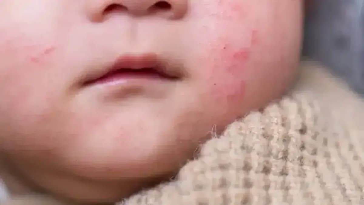 Besin Alerjileri Çocuklarda Neden Salgın Gibi Yayılıyor? Uzman Uyarıyor