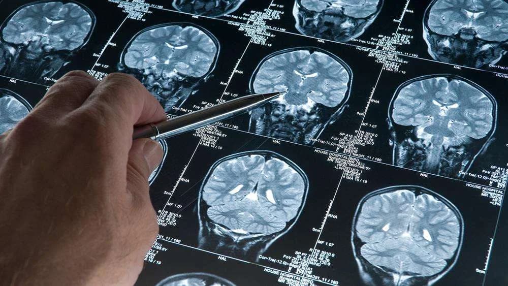 Yeni Araştırma: Alzheimer, Belirtiler Ortaya Çıkmadan Yıllar Önce Başlıyor Olabilir