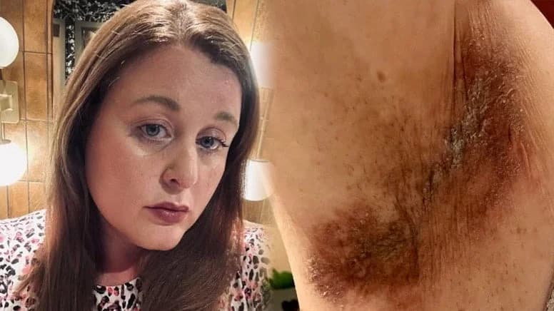Mitchum roll-on krizi: Üç kadın Revlon’a cilt yanığı davası açtı