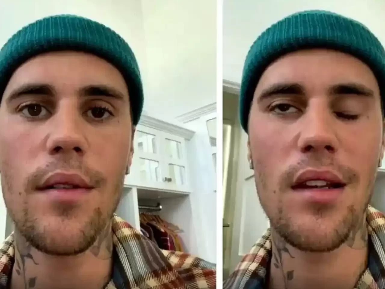 Justin Bieber’ın Yüz Felci Geçirmesine Neden Olan Hastalık Ne?